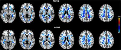 Pronounced Structural and Functional Damage in Early Adult Pediatric-Onset Multiple Sclerosis with No or Minimal Clinical Disability